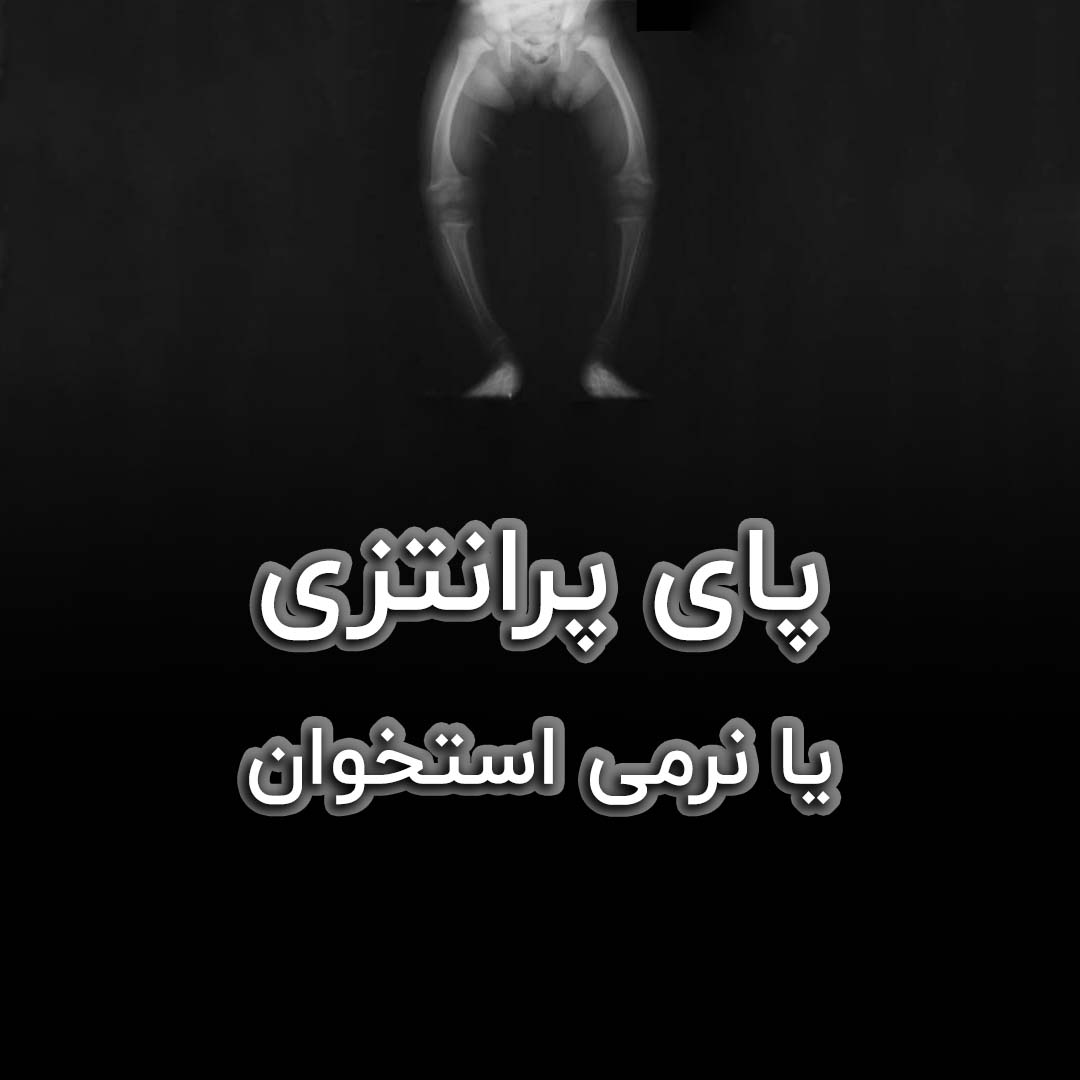 پای پرانتزی یا نرمی استخوان