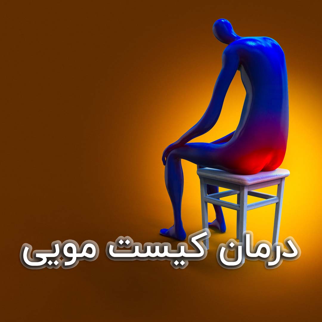 درمان کیست مویی